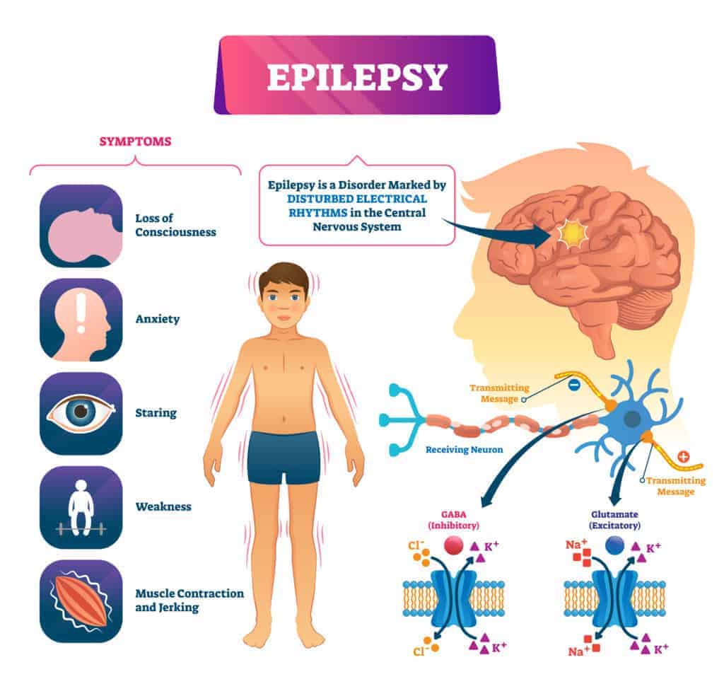 Dravet Syndrome epilepsy 