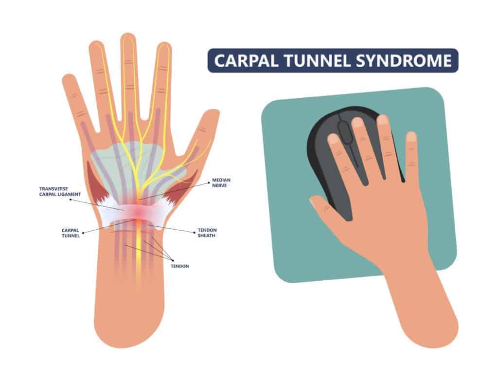 carpal tunnel infographic. CBD oil for carpal tunnel. 