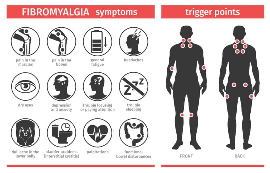 Symptoms and signs of fibromyalgia. Tender points. Infographics. Template for use in medical agitation. Vector illustration, flat icons. CBD oil for fibromyalgia