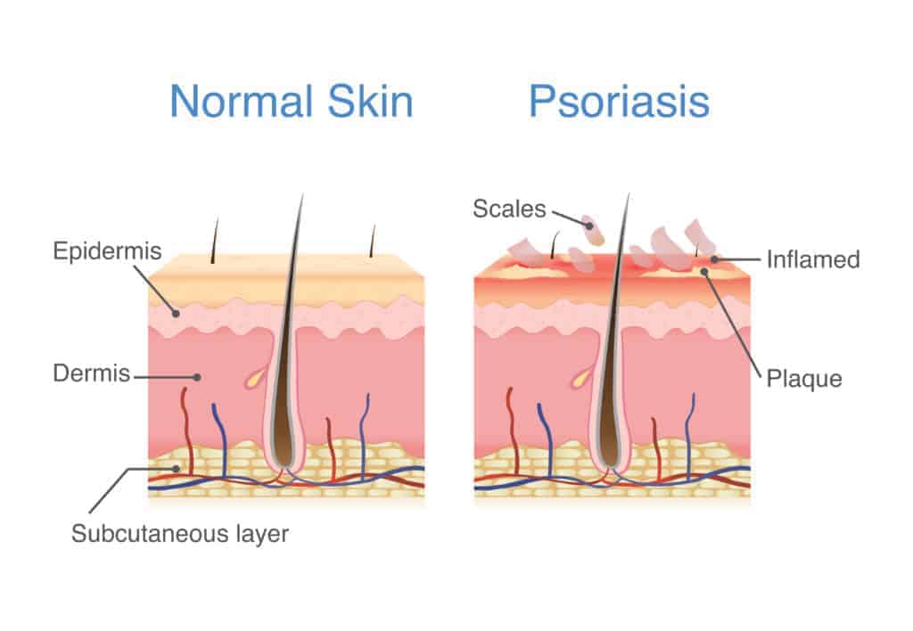Normal skin layer and skin when plaque psoriasis signs. CBD oil for psoriasis 